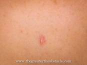 Wk6 Random injury…loss of skin to décolletage due to zip. Stingy!