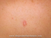 Wk6 Random injury…loss of skin to décolletage due to zip. Stingy!